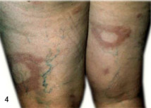 04_hanseniase-214x153