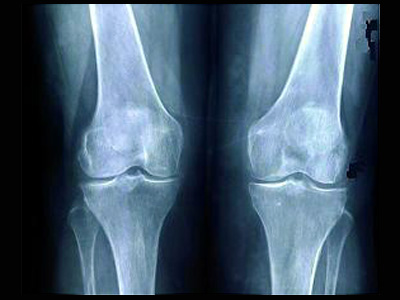 A_024bf579320b95cf5cdb03a8c817d347joelho_osteoartrose