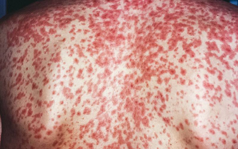 confirmado-caso-de-sarampo-em-lisboa