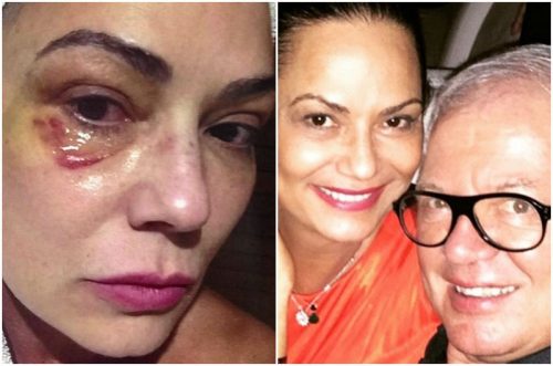 luiza-brunet-machucada-colagem-500x331