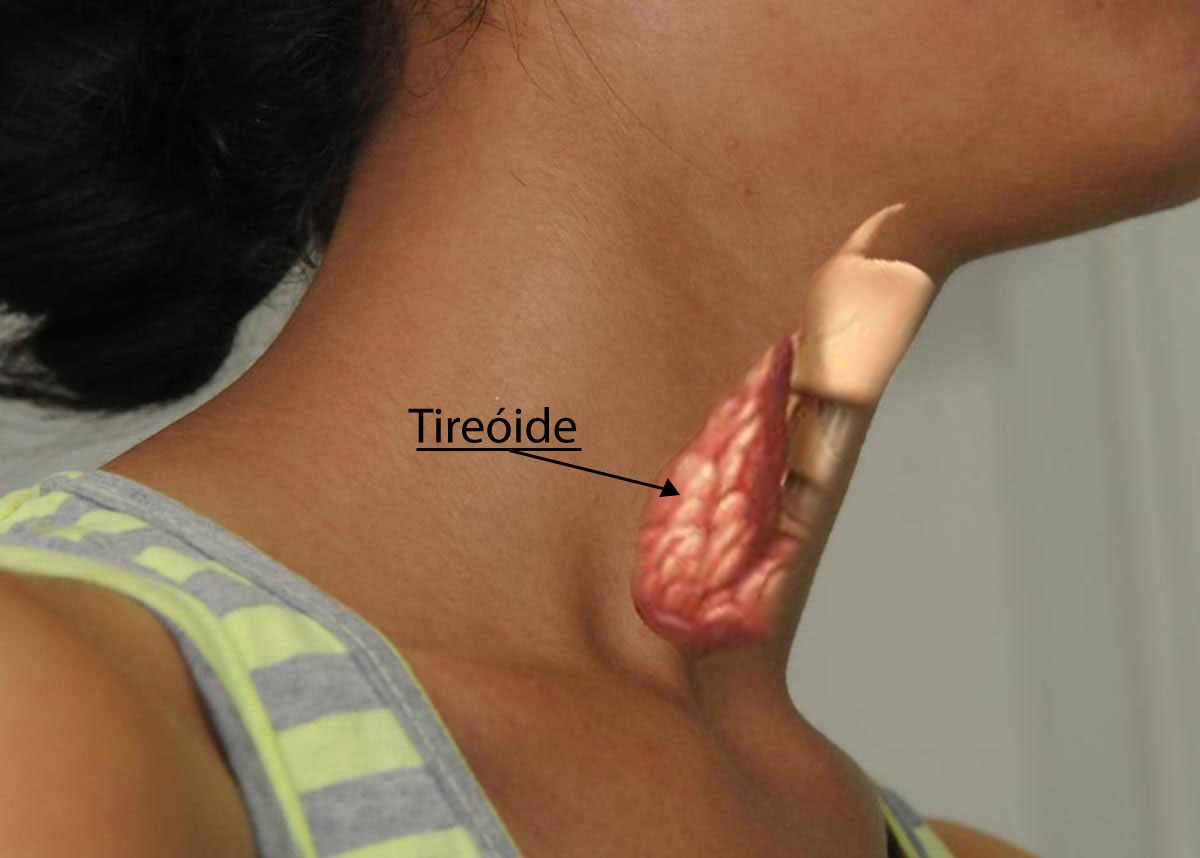 montagem-tireoide
