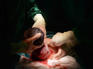 parto-cesarea-medico-retirando-o-bebe-foto-arttershutterstockcom-00000000000138D5